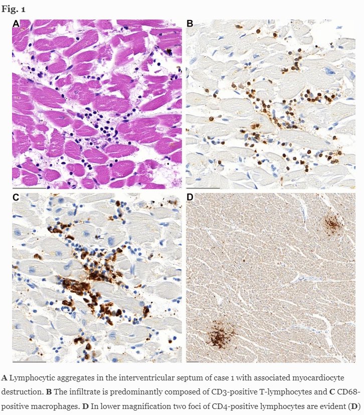 Lymphocyte immune cells (white blood cells) are shown in blue and brown among the heart tissue, causing localised inflammation that proved fatal