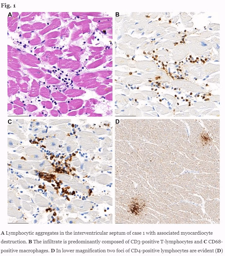 Le cellule immunitarie dei linfociti (globuli bianchi) sono mostrate in blu e marrone nel tessuto cardiaco, causando un'infiammazione localizzata che si è rivelata fatale
